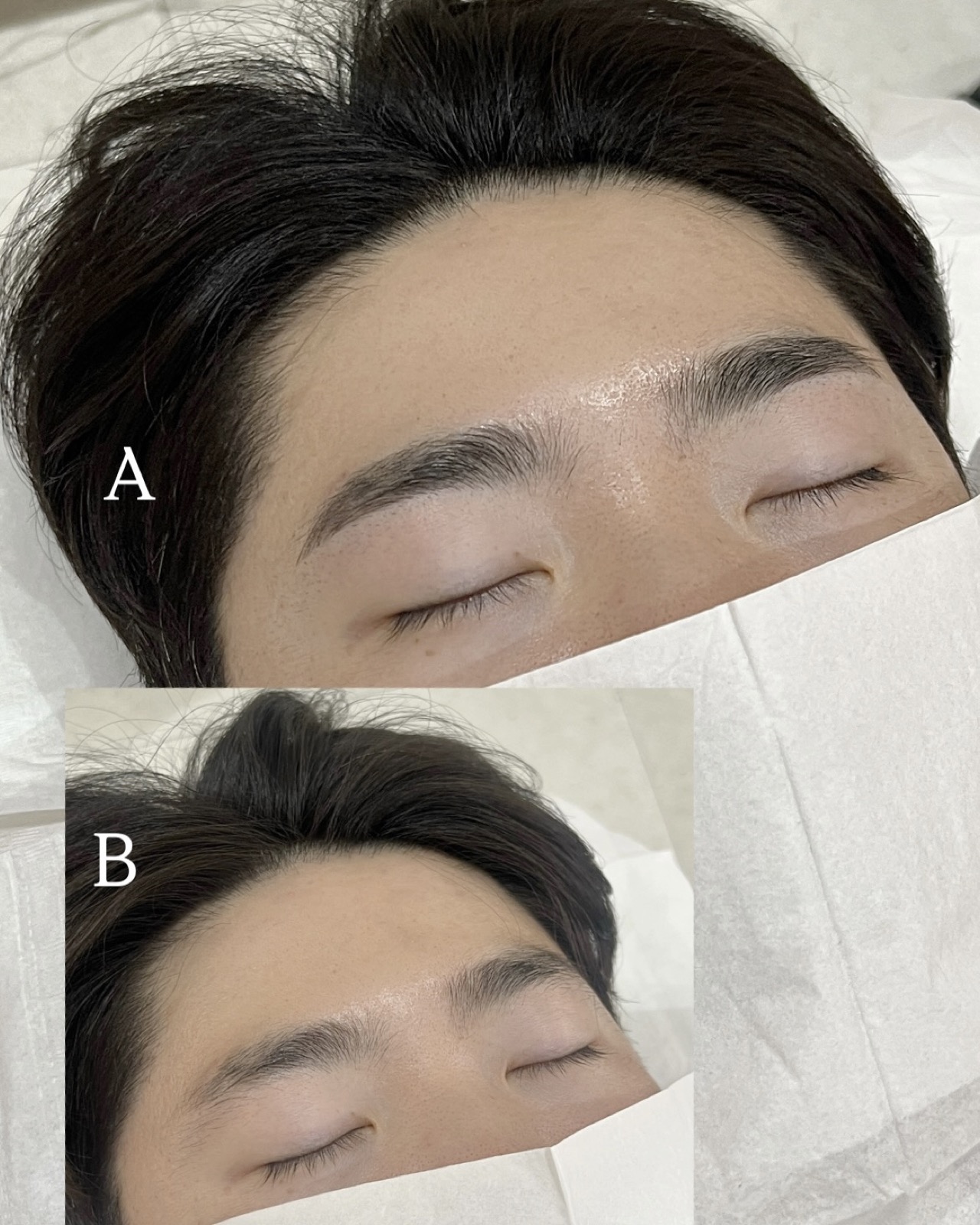 남성 콤보 눈썹 시술 전후 비교